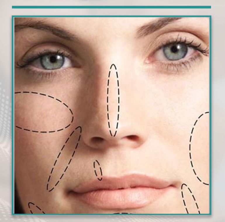Septoplasty Surgery